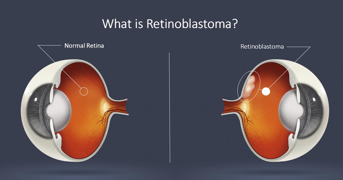 Retinoblastoma Symptoms, Causes and Treatment - Contact Lens King Blog