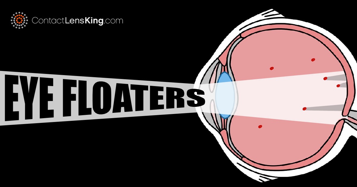 Seeing Floaters in Vision | Treating Black Dots in Eye - Contact Lens ...