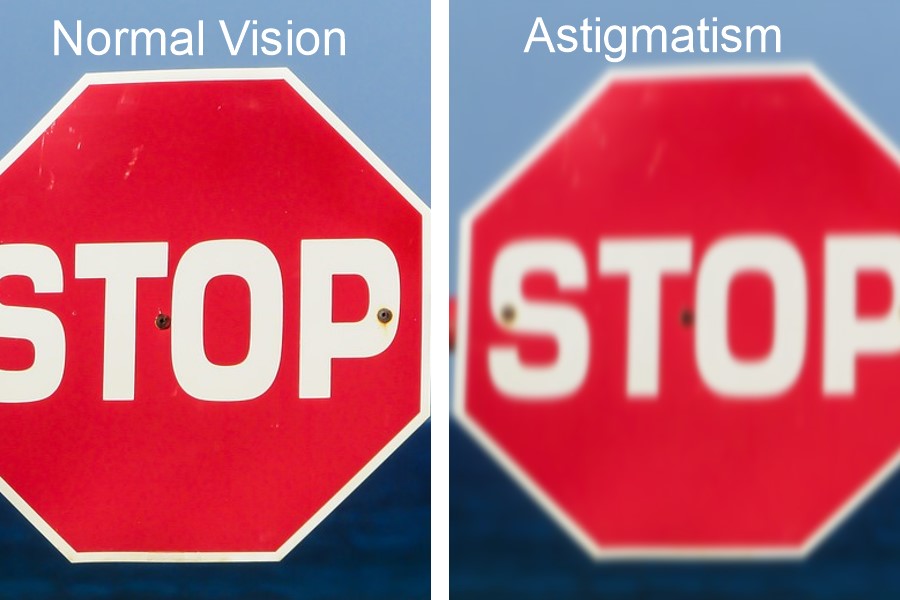 Astigmatism Symptoms, Treatments and Cure - Contact Lens King Blog